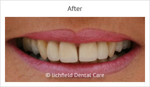 Patient case 5 after