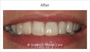 Patient case 4 after