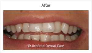 Patient case 1 after