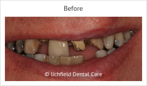 Patient case 1 after