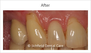 Patient case 5 after