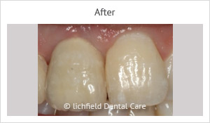 Patient case 6 after