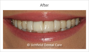 Patient case 4 after