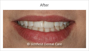 Patient case 5 after